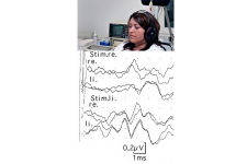 AEP (acoustically evoked potentials)