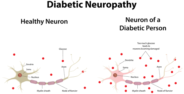 diabetic neuropathy dubai