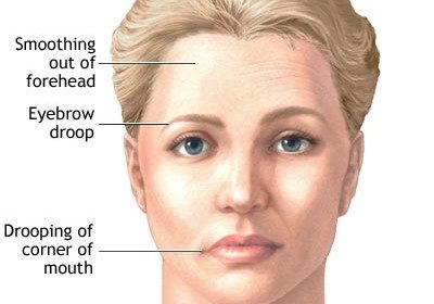 myasthenia gravis sip of water bladder before medication