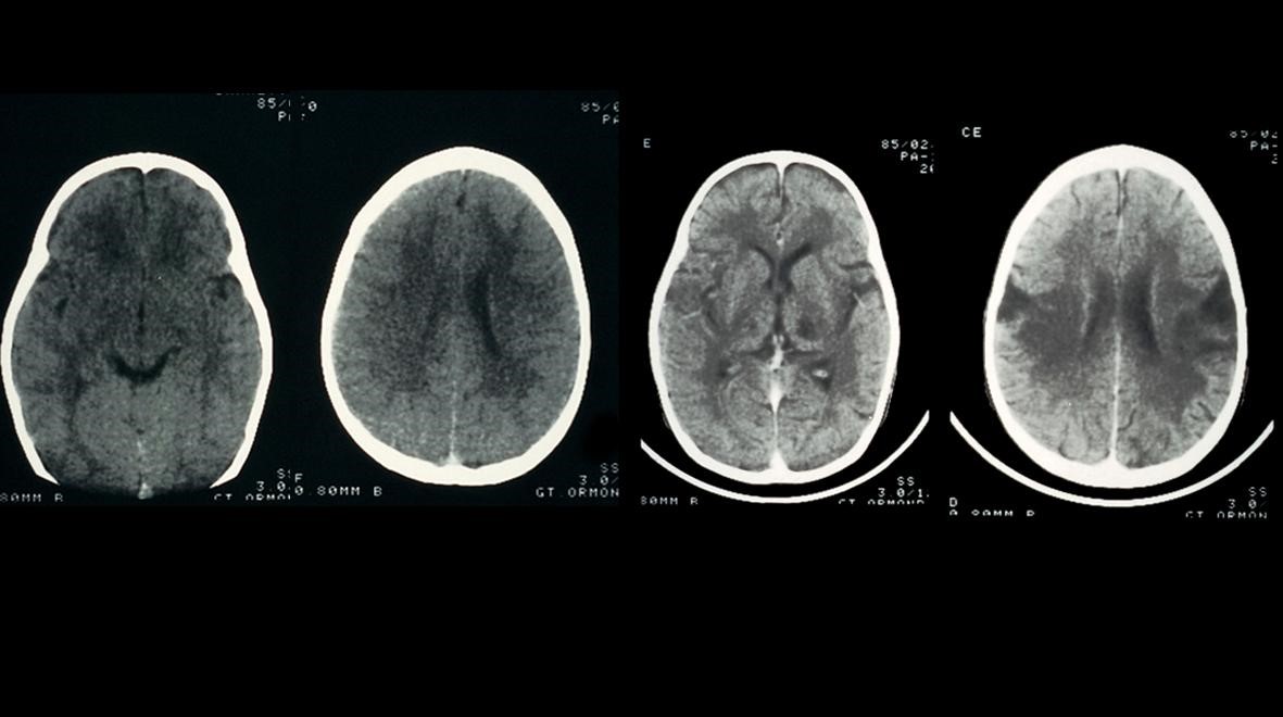 Differences Between Meningitis And Encephalitis | German Neuroscience ...